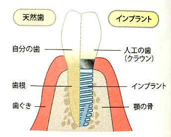 インプラント構造